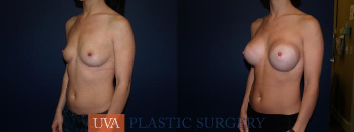 Breast Augmentation Case 72 Before & After View #4 | Richmond, Charlottesville & Roanoke, VA | University of Virginia Plastic Surgery
