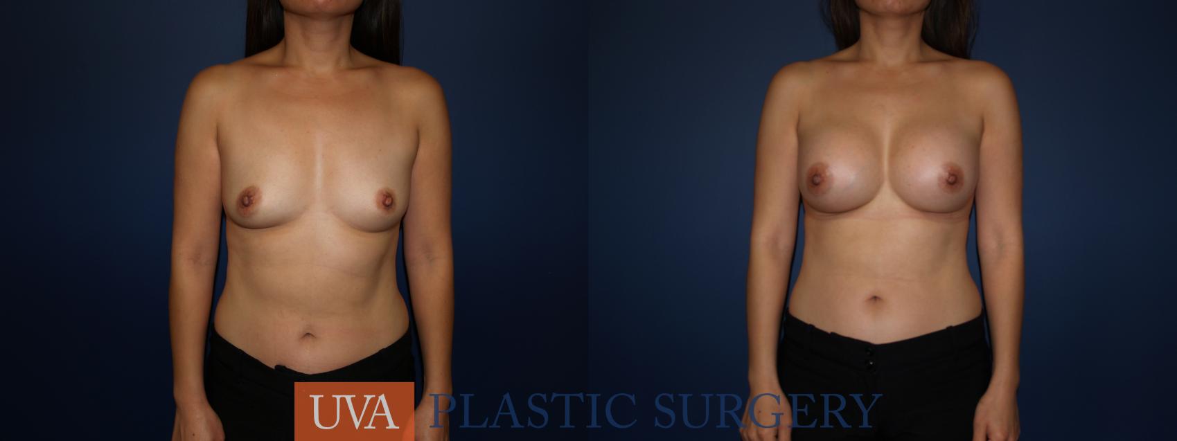 Breast Augmentation Case 73 Before & After View #1 | Richmond, Charlottesville & Roanoke, VA | University of Virginia Plastic Surgery