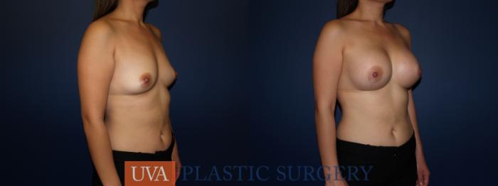 Breast Augmentation Case 73 Before & After View #2 | Richmond, Charlottesville & Roanoke, VA | University of Virginia Plastic Surgery
