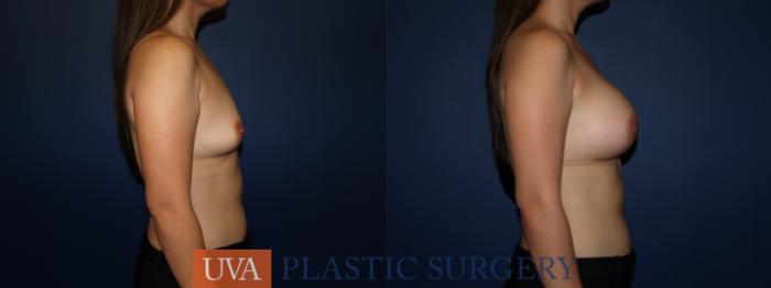 Breast Augmentation Case 73 Before & After View #3 | Richmond, Charlottesville & Roanoke, VA | University of Virginia Plastic Surgery
