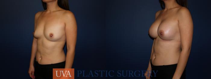 Breast Augmentation Case 73 Before & After View #4 | Richmond, Charlottesville & Roanoke, VA | University of Virginia Plastic Surgery