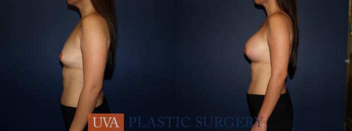 Breast Augmentation Case 73 Before & After View #5 | Richmond, Charlottesville & Roanoke, VA | University of Virginia Plastic Surgery