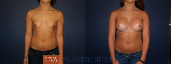 Breast Augmentation Case 74 Before & After View #1 | Charlottesville & Fishersville, VA | University of Virginia Plastic Surgery