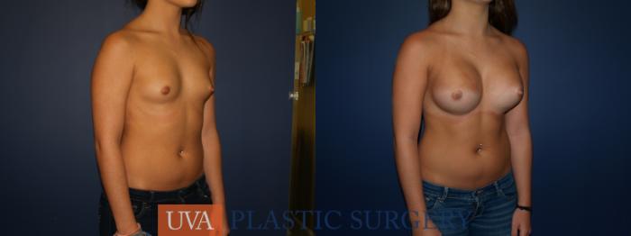 Breast Augmentation Case 74 Before & After View #2 | Charlottesville & Fishersville, VA | University of Virginia Plastic Surgery
