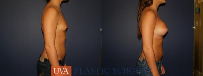 Breast Augmentation Case 74 Before & After View #3 | Charlottesville & Fishersville, VA | University of Virginia Plastic Surgery