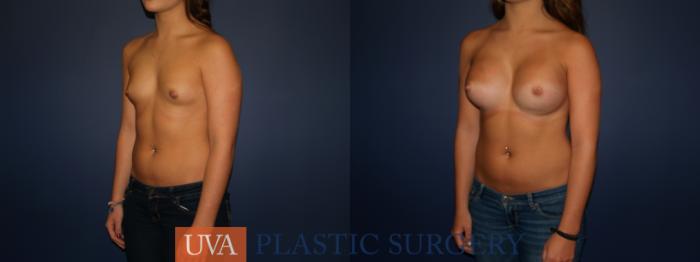 Breast Augmentation Case 74 Before & After View #4 | Charlottesville & Fishersville, VA | University of Virginia Plastic Surgery