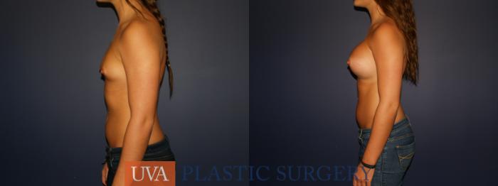 Breast Augmentation Case 74 Before & After View #5 | Charlottesville & Fishersville, VA | University of Virginia Plastic Surgery