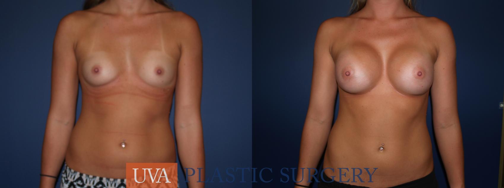 Breast Augmentation Case 79 Before & After View #1 | Richmond, Charlottesville & Roanoke, VA | University of Virginia Plastic Surgery