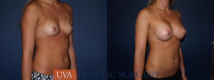 Breast Augmentation Case 79 Before & After View #2 | Richmond, Charlottesville & Roanoke, VA | University of Virginia Plastic Surgery