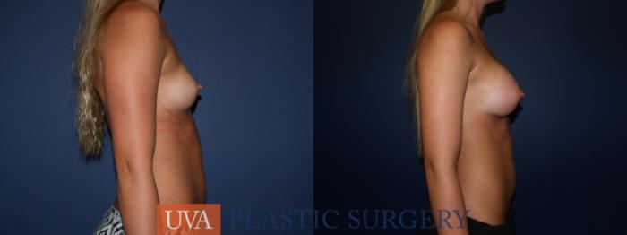 Breast Augmentation Case 79 Before & After View #3 | Richmond, Charlottesville & Roanoke, VA | University of Virginia Plastic Surgery