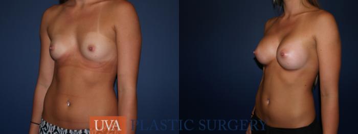 Breast Augmentation Case 79 Before & After View #4 | Richmond, Charlottesville & Roanoke, VA | University of Virginia Plastic Surgery