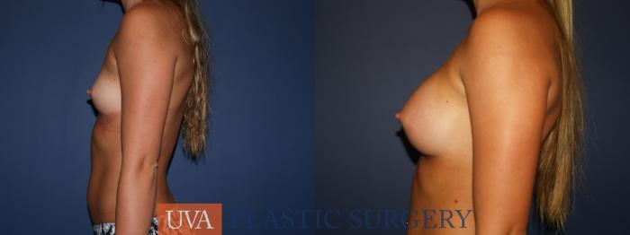 Breast Augmentation Case 79 Before & After View #5 | Richmond, Charlottesville & Roanoke, VA | University of Virginia Plastic Surgery