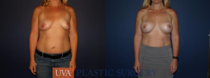 Breast Augmentation Case 85 Before & After View #1 | Richmond, Charlottesville & Roanoke, VA | University of Virginia Plastic Surgery