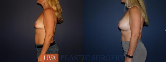 Breast Augmentation Case 85 Before & After View #3 | Richmond, Charlottesville & Roanoke, VA | University of Virginia Plastic Surgery