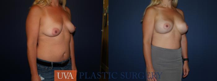 Breast Augmentation Case 85 Before & After View #4 | Richmond, Charlottesville & Roanoke, VA | University of Virginia Plastic Surgery