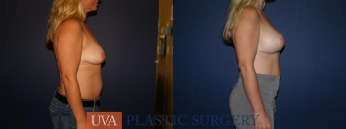 Breast Augmentation Case 85 Before & After View #5 | Richmond, Charlottesville & Roanoke, VA | University of Virginia Plastic Surgery