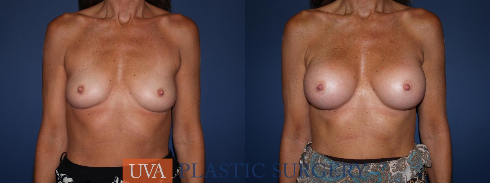 Breast Augmentation Case 96 Before & After View #1 | Charlottesville & Fishersville, VA | University of Virginia Plastic Surgery