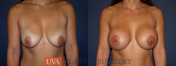 Breast Augmentation Case 98 Before & After View #1 | Richmond, Charlottesville & Roanoke, VA | University of Virginia Plastic Surgery