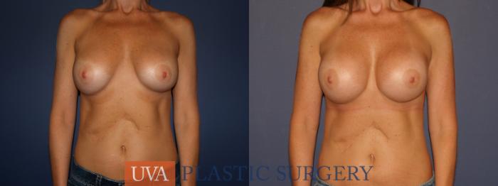 Breast Implant Exchange Case 109 Before & After View #1 | Richmond, Charlottesville & Roanoke, VA | University of Virginia Plastic Surgery