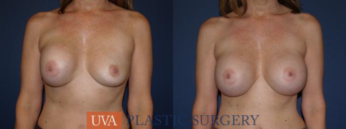 Breast Implant Exchange Case 113 Before & After View #1 | Richmond, Charlottesville & Roanoke, VA | University of Virginia Plastic Surgery