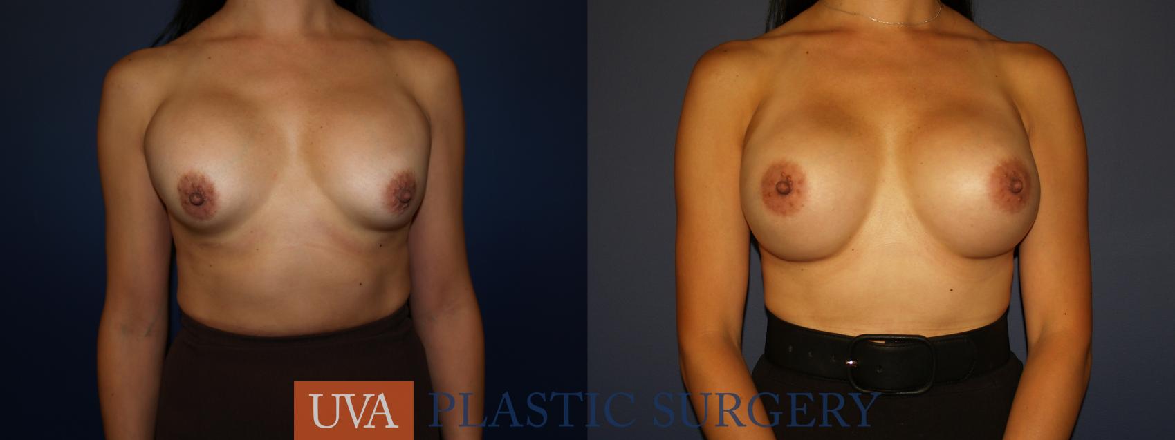 Breast Implant Exchange Case 99 Before & After View #1 | Richmond, Charlottesville & Roanoke, VA | University of Virginia Plastic Surgery
