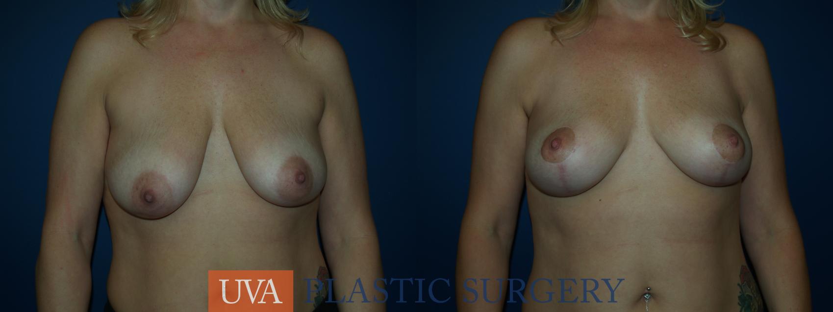 Breast Lift (Mastopexy) Case 36 Before & After View #1 | Charlottesville & Fishersville, VA | University of Virginia Plastic Surgery
