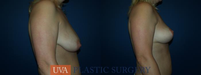 Breast Lift (Mastopexy) Case 36 Before & After View #3 | Richmond, Charlottesville & Roanoke, VA | University of Virginia Plastic Surgery