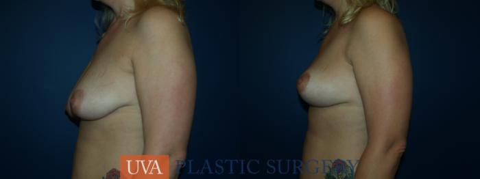 Breast Lift (Mastopexy) Case 36 Before & After View #5 | Richmond, Charlottesville & Roanoke, VA | University of Virginia Plastic Surgery
