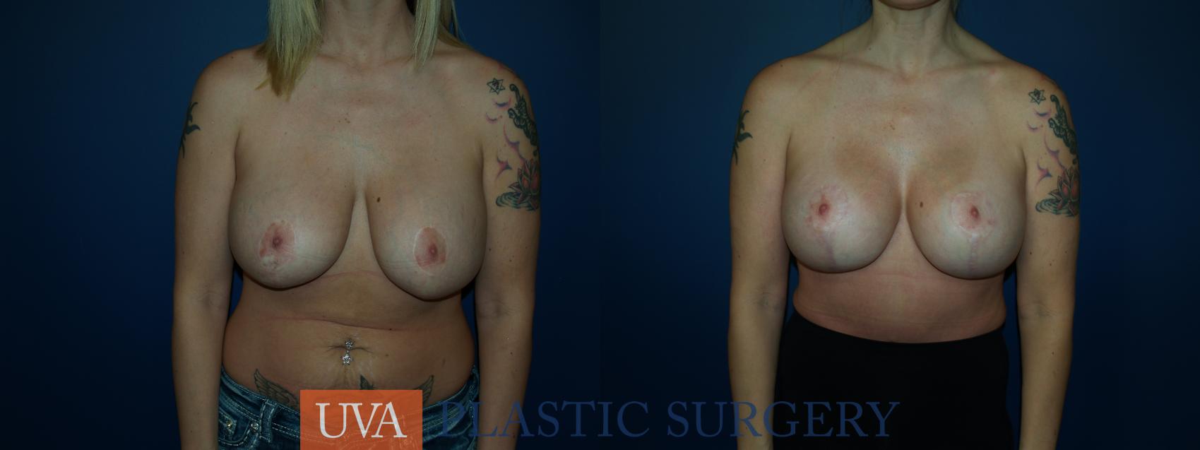 Breast Lift (Mastopexy) Case 60 Before & After View #1 | Charlottesville & Fishersville, VA | University of Virginia Plastic Surgery