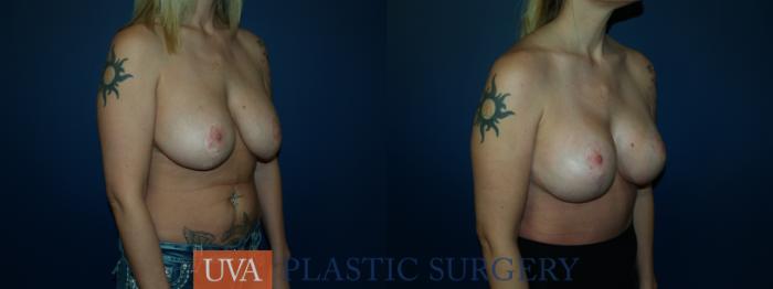 Breast Lift (Mastopexy) Case 60 Before & After View #2 | Charlottesville & Fishersville, VA | University of Virginia Plastic Surgery