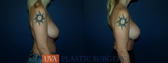 Breast Lift (Mastopexy) Case 60 Before & After View #3 | Charlottesville & Fishersville, VA | University of Virginia Plastic Surgery