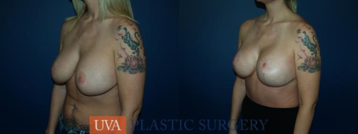 Breast Lift (Mastopexy) Case 60 Before & After View #4 | Charlottesville & Fishersville, VA | University of Virginia Plastic Surgery