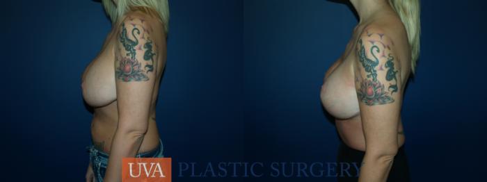 Breast Lift (Mastopexy) Case 60 Before & After View #5 | Charlottesville & Fishersville, VA | University of Virginia Plastic Surgery