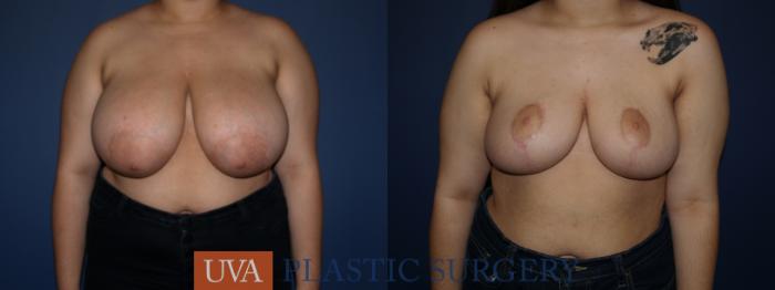 Breast Reduction Case 101 Before & After View #1 | Charlottesville & Fishersville, VA | University of Virginia Plastic Surgery