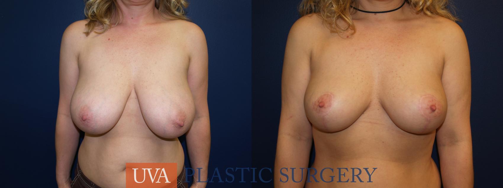 Breast Reduction Case 4 Before & After View #1 | Richmond, Charlottesville & Roanoke, VA | University of Virginia Plastic Surgery