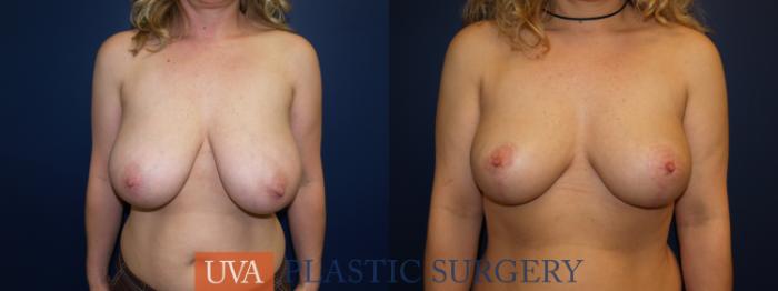 Breast Reduction Case 4 Before & After View #1 | Richmond, Charlottesville & Roanoke, VA | University of Virginia Plastic Surgery