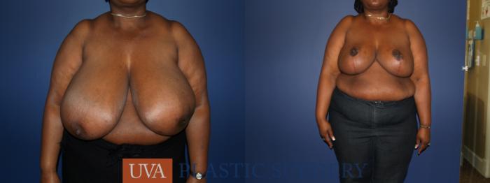 Breast Reduction Case 75 Before & After View #1 | Charlottesville & Fishersville, VA | University of Virginia Plastic Surgery