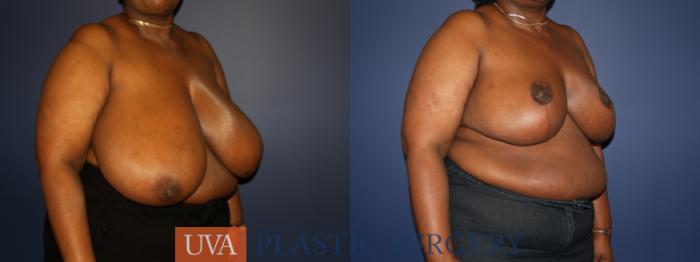 Breast Reduction Case 75 Before & After View #2 | Richmond, Charlottesville & Roanoke, VA | University of Virginia Plastic Surgery