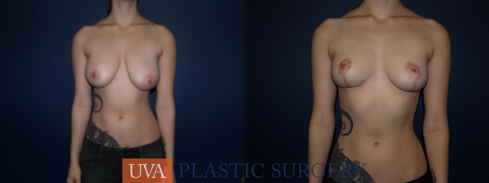 Breast Reduction Case 76 Before & After View #1 | Charlottesville & Fishersville, VA | University of Virginia Plastic Surgery