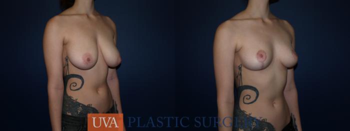 Breast Reduction Case 76 Before & After View #2 | Charlottesville & Fishersville, VA | University of Virginia Plastic Surgery