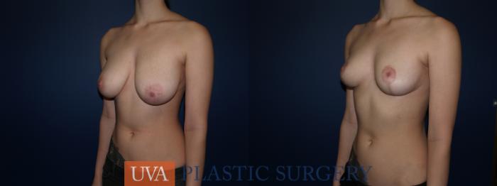 Breast Reduction Case 76 Before & After View #4 | Charlottesville & Fishersville, VA | University of Virginia Plastic Surgery