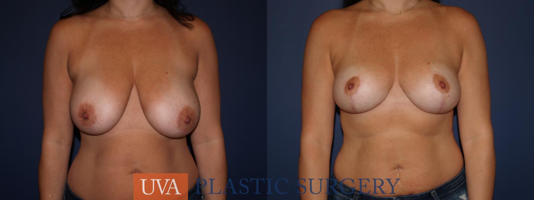 Breast Reduction Case 97 Before & After View #1 | Charlottesville & Fishersville, VA | University of Virginia Plastic Surgery