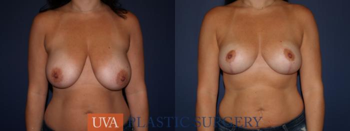 Breast Reduction Case 97 Before & After View #1 | Richmond, Charlottesville & Roanoke, VA | University of Virginia Plastic Surgery