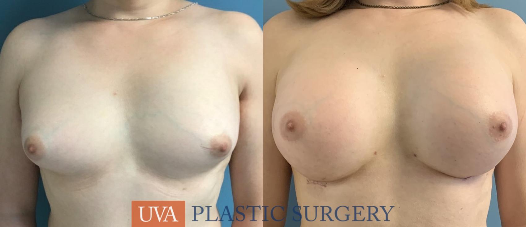 Chest Feminization Case 235 Before & After Front | Charlottesville & Fishersville, VA | University of Virginia Plastic Surgery