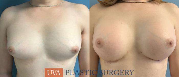 Chest Feminization Case 235 Before & After Front | Richmond, Charlottesville & Roanoke, VA | University of Virginia Plastic Surgery