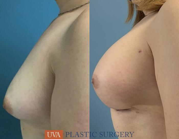 Chest Feminization Case 235 Before & After Left Side | Richmond, Charlottesville & Roanoke, VA | University of Virginia Plastic Surgery