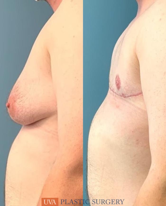 Chest Masculinization Case 230 Before & After Left Side | Richmond, Charlottesville & Roanoke, VA | University of Virginia Plastic Surgery