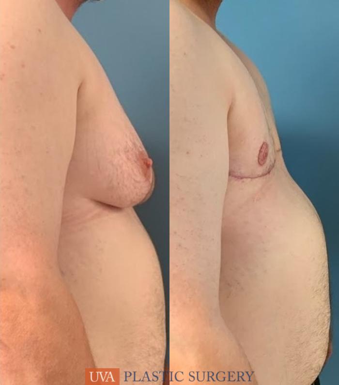 Chest Masculinization Case 230 Before & After Right Side | Richmond, Charlottesville & Roanoke, VA | University of Virginia Plastic Surgery