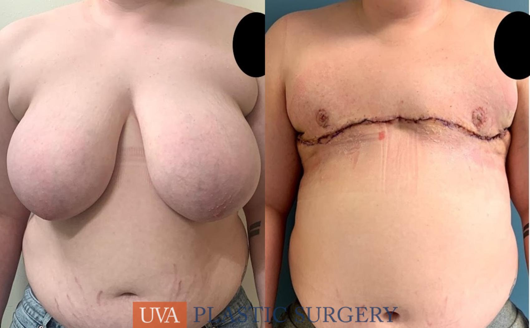 Chest Masculinization Case 232 Before & After Front | Charlottesville & Fishersville, VA | University of Virginia Plastic Surgery