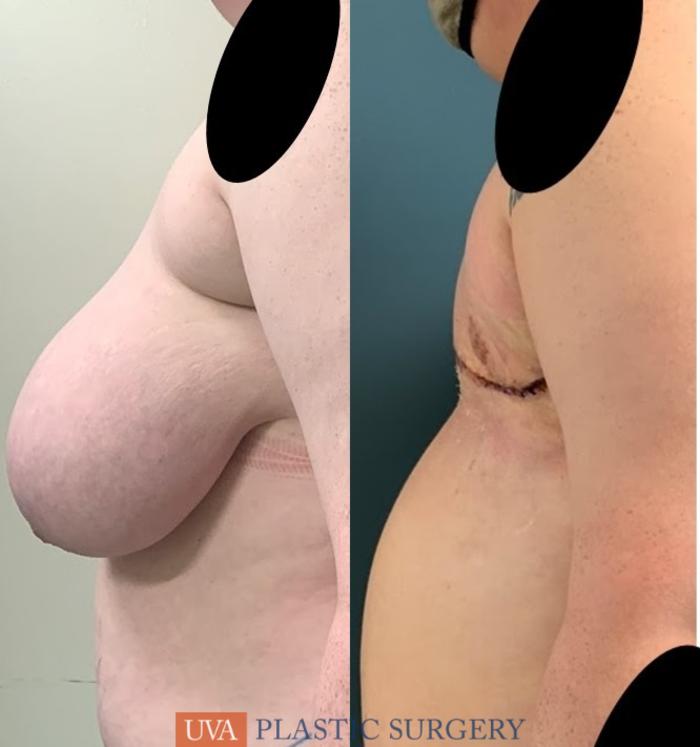 Chest Masculinization Case 232 Before & After Left Side | Richmond, Charlottesville & Roanoke, VA | University of Virginia Plastic Surgery